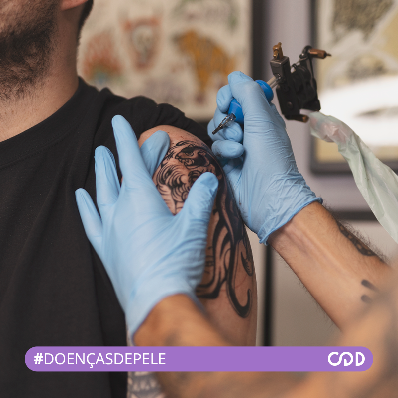 Quem tem doenças crônicas de pele pode fazer tatuagens?